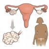 Поликистоз яичников: симптомы, причины и лечение Поликистоз яичников причины лечение